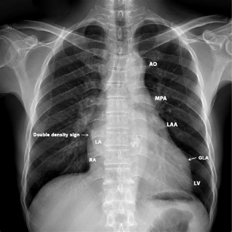 how to cheat chest x ray results|Chest (PA view) .